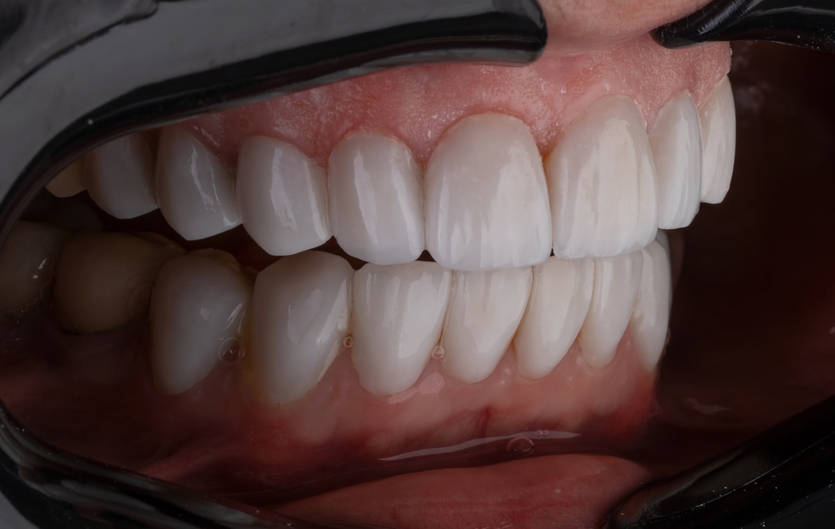 Dentes restaurados com facetas de porcelana