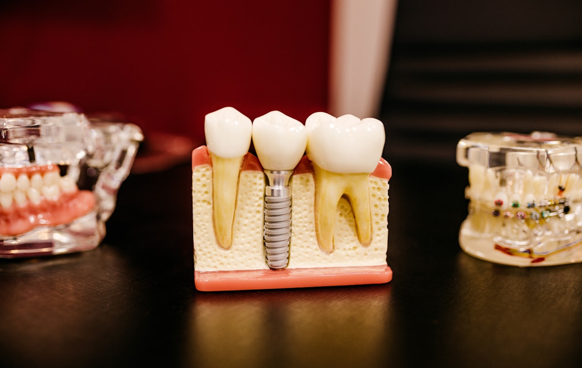 Modelo de implante dentário de titânio