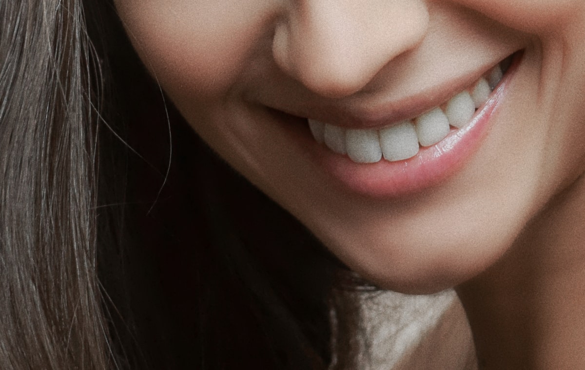 Sorriso natural com lentes de contato dental